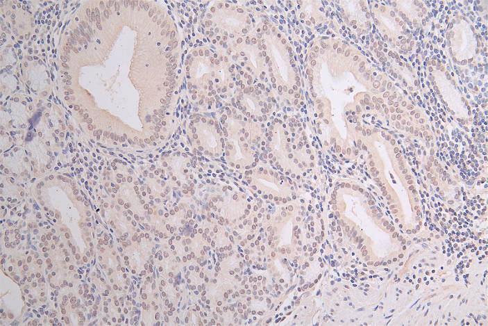 IHC image of RAC07401 diluted at 1:100 and staining in paraffin-embedded human gastric cancer performed on a Leica BondTM system. After dewaxing and hydration, antigen retrieval was mediated by high pressure in a citrate buffer (pH 6.0). Section was blocked with 10% normal goat serum 30min at RT. Then primary antibody (1% BSA) was incubated at 4Â°C overnight. The primary is detected by a Goat anti-rabbit polymer IgG labeled by HRP and visualized using 0.07% DAB.