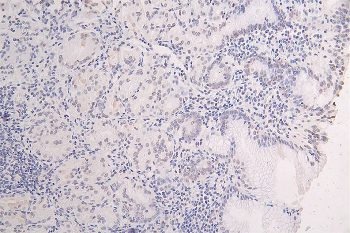 IHC image of RAC07402 diluted at 1:100 and staining in paraffin-embedded human gastric cancer performed on a Leica BondTM system. After dewaxing and hydration, antigen retrieval was mediated by high pressure in a citrate buffer (pH 6.0). Section was blocked with 10% normal goat serum 30min at RT. Then primary antibody (1% BSA) was incubated at 4Â°C overnight. The primary is detected by a Goat anti-rabbit polymer IgG labeled by HRP and visualized using 0.08% DAB.