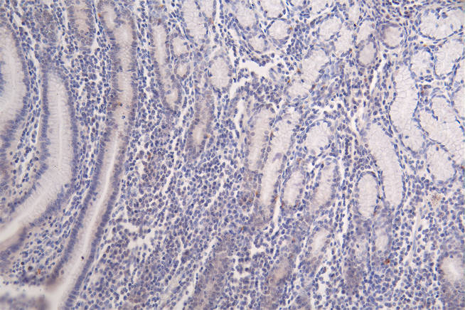 IHC image of RAC07403 diluted at 1:100 and staining in paraffin-embedded human breast cancer performed on a Leica BondTM system. After dewaxing and hydration, antigen retrieval was mediated by high pressure in a citrate buffer (pH 6.0). Section was blocked with 10% normal goat serum 30min at RT. Then primary antibody (1% BSA) was incubated at 4Â°C overnight. The primary is detected by a Goat anti-rabbit polymer IgG labeled by HRP and visualized using 0.09% DAB.