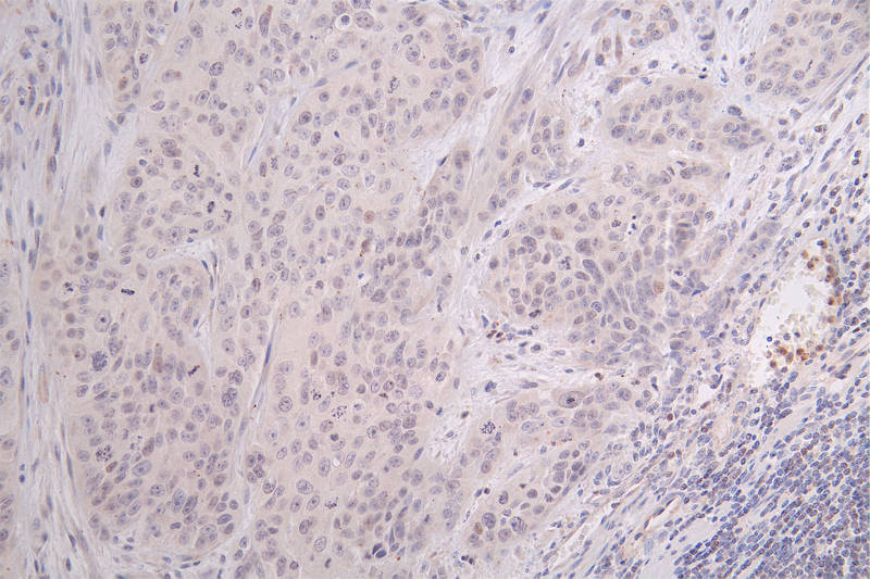 IHC image of RAC07403 diluted at 1:100 and staining in paraffin-embedded human gastric cancer performed on a Leica BondTM system. After dewaxing and hydration, antigen retrieval was mediated by high pressure in a citrate buffer (pH 6.0). Section was blocked with 10% normal goat serum 30min at RT. Then primary antibody (1% BSA) was incubated at 4Â°C overnight. The primary is detected by a Goat anti-rabbit polymer IgG labeled by HRP and visualized using 0.09% DAB.