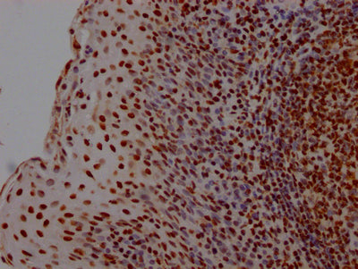 IHC image of RAC07406 diluted at 1:100 and staining in paraffin-embedded human tonsil tissue performed on a Leica BondTM system. After dewaxing and hydration, antigen retrieval was mediated by high pressure in a citrate buffer (pH 6.0). Section was blocked with 10% normal goat serum 30min at RT. Then primary antibody (1% BSA) was incubated at 4? overnight. The primary is detected by a Goat anti-rabbit IgG polymer labeled by HRP and visualized using 0.05% DAB.