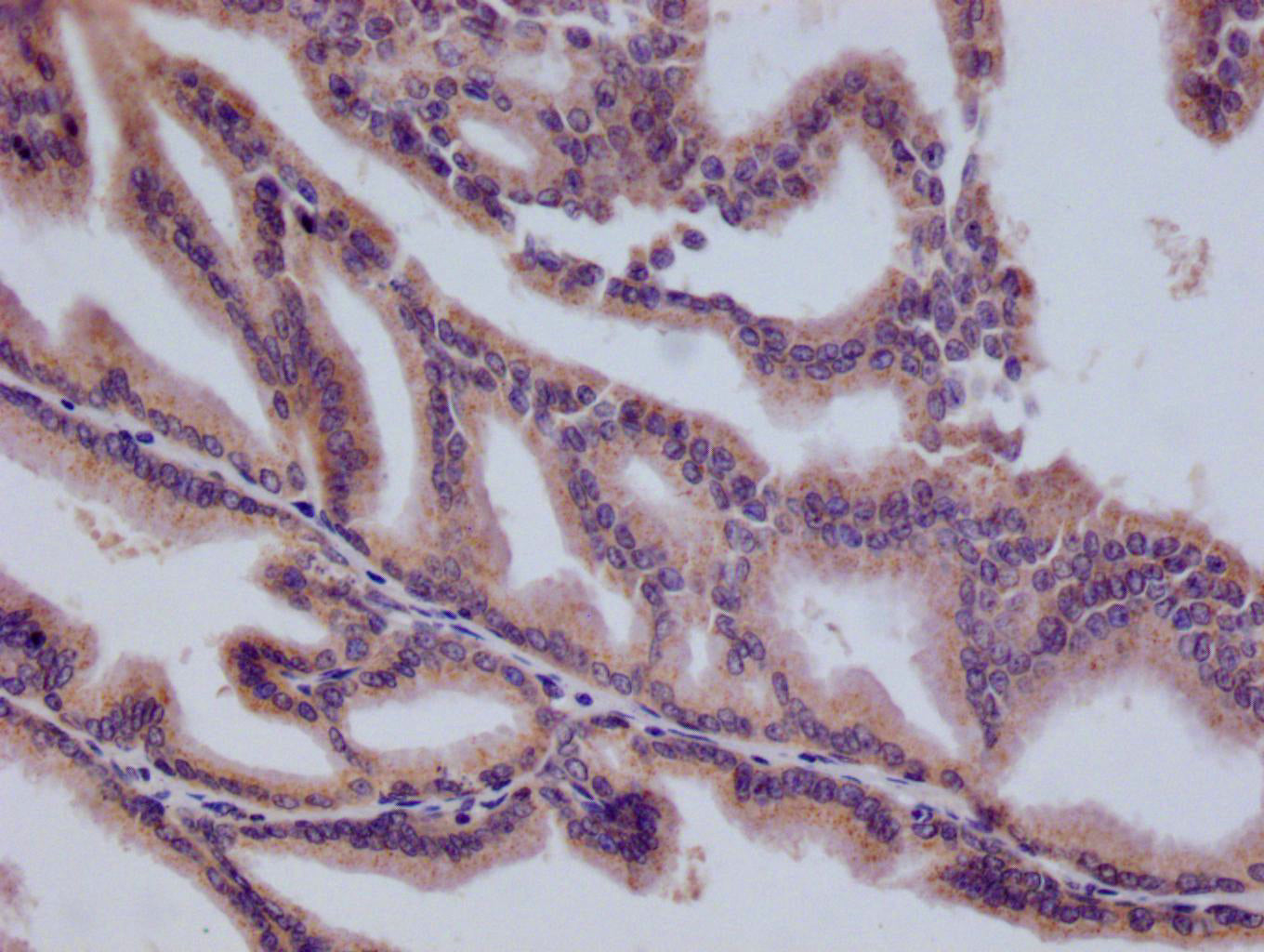 IHC image of RAC07407 diluted at 1:100 and staining in paraffin-embedded human prostate tissue performed on a Leica BondTM system. After dewaxing and hydration, antigen retrieval was mediated by high pressure in a citrate buffer (pH 6.0). Section was blocked with 10% normal goat serum 30min at RT. Then primary antibody (1% BSA) was incubated at 4Â°C overnight. The primary is detected by a Goat anti-rabbit polymer IgG labeled by HRP and visualized using 0.05% DAB.