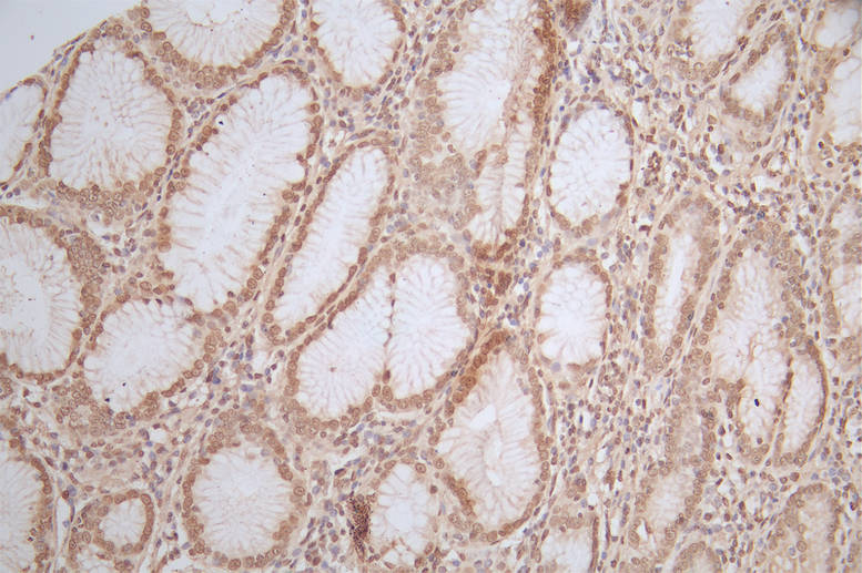 IHC image of RAC07409 diluted at 1:50 and staining in paraffin-embedded human gastric cancer performed on a Leica BondTM system. After dewaxing and hydration, antigen retrieval was mediated by high pressure in a citrate buffer (pH 6.0). Section was blocked with 10% normal goat serum 30min at RT. Then primary antibody (1% BSA) was incubated at 4Â°C overnight. The primary is detected by a Goat anti-rabbit polymer IgG labeled by HRP and visualized using 0.75% DAB.