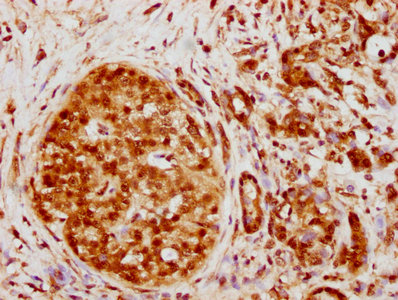 IHC image of RAC07412 diluted at 1:130.5 and staining in paraffin-embedded human pancreatic cancer performed on a Leica BondTM system. After dewaxing and hydration, antigen retrieval was mediated by high pressure in a citrate buffer (pH 6.0). Section was blocked with 10% normal goat serum 30min at RT. Then primary antibody (1% BSA) was incubated at 4? overnight. The primary is detected by a biotinylated secondary antibody and visualized using an HRP conjugated SP system.