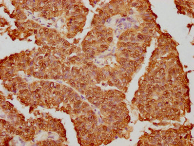 IHC image of RAC07412 diluted at 1:130.5 and staining in paraffin-embedded human cervical cancer performed on a Leica BondTM system. After dewaxing and hydration, antigen retrieval was mediated by high pressure in a citrate buffer (pH 6.0). Section was blocked with 10% normal goat serum 30min at RT. Then primary antibody (1% BSA) was incubated at 4? overnight. The primary is detected by a biotinylated secondary antibody and visualized using an HRP conjugated SP system.