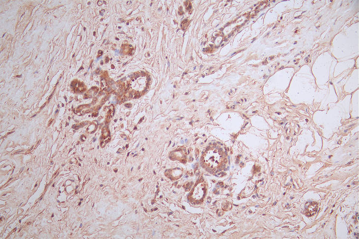 IHC image of RAC07414 diluted at 1:100 and staining in paraffin-embedded human breast cancer performed on a Leica BondTM system. After dewaxing and hydration, antigen retrieval was mediated by high pressure in a citrate buffer (pH 6.0). Section was blocked with 10% normal goat serum 30min at RT. Then primary antibody (1% BSA) was incubated at 4Â°C overnight. The primary is detected by a Goat anti-rabbit polymer IgG labeled by HRP and visualized using 0.50% DAB.