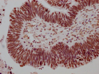 IHC image of RAC07415 diluted at 1:100 and staining in paraffin-embedded human ovarian cancer performed on a Leica BondTM system. After dewaxing and hydration, antigen retrieval was mediated by high pressure in a citrate buffer (pH 6.0). Section was blocked with 10% normal goat serum 30min at RT. Then primary antibody (1% BSA) was incubated at 4? overnight. The primary is detected by a Goat anti-rabbit IgG polymer labeled by HRP and visualized using 0.05% DAB.