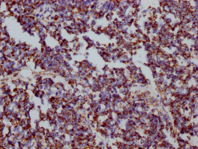 IHC image of RAC07417 diluted at 1:100 and staining in paraffin-embedded human liver cancer performed on a Leica BondTM system. After dewaxing and hydration, antigen retrieval was mediated by high pressure in a citrate buffer (pH 6.0). Section was blocked with 10% normal goat serum 30min at RT. Then primary antibody (1% BSA) was incubated at 4? overnight. The primary is detected by a Goat anti-rabbit IgG polymer labeled by HRP and visualized using 0.05% DAB.