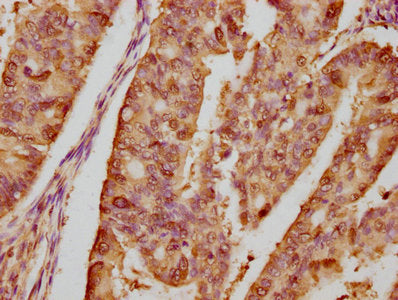 IHC image of RAC07418 diluted at 1:80 and staining in paraffin-embedded human endometrial cancer performed on a Leica BondTM system. After dewaxing and hydration, antigen retrieval was mediated by high pressure in a citrate buffer (pH 6.0). Section was blocked with 10% normal goat serum 30min at RT. Then primary antibody (1% BSA) was incubated at 4? overnight. The primary is detected by a biotinylated secondary antibody and visualized using an HRP conjugated SP system.