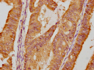 IHC image of RAC07419 diluted at 1:87.5 and staining in paraffin-embedded human endometrial cancer performed on a Leica BondTM system. After dewaxing and hydration, antigen retrieval was mediated by high pressure in a citrate buffer (pH 6.0). Section was blocked with 10% normal goat serum 30min at RT. Then primary antibody (1% BSA) was incubated at 4? overnight. The primary is detected by a biotinylated secondary antibody and visualized using an HRP conjugated SP system.