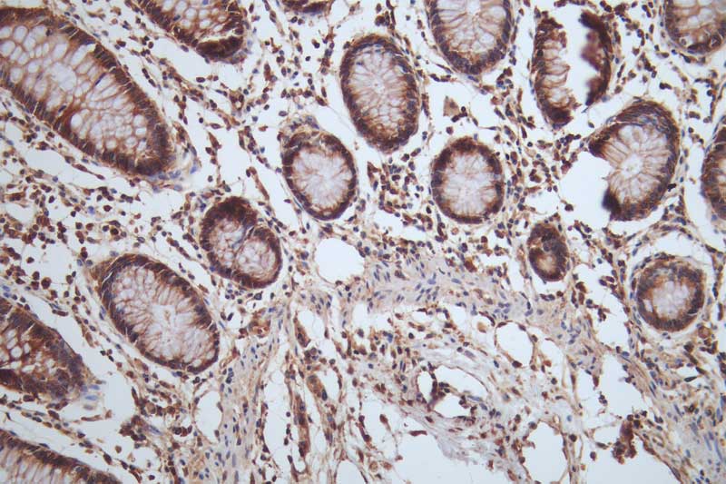 IHC image of RAC07421 diluted at 1:100 and staining in paraffin-embedded human colon tissue performed on a Leica BondTM system. After dewaxing and hydration, antigen retrieval was mediated by high pressure in a citrate buffer (pH 6.0). Section was blocked with 10% normal goat serum 30min at RT. Then primary antibody (1% BSA) was incubated at 4Â°C overnight. The primary is detected by a Goat anti-rabbit polymer IgG labeled by HRP and visualized using 0.05% DAB.