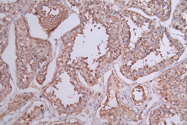 IHC image of RAC07422 diluted at 1:50 and staining in paraffin-embedded human testis tissue performed on a Leica BondTM system. After dewaxing and hydration, antigen retrieval was mediated by high pressure in a citrate buffer (pH 6.0). Section was blocked with 10% normal goat serum 30min at RT. Then primary antibody (1% BSA) was incubated at 4Â°C overnight. The primary is detected by a Goat anti-rabbit polymer IgG labeled by HRP and visualized using 0.74% DAB.