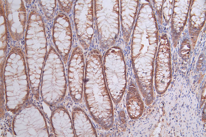 IHC image of RAC07422 diluted at 1:50 and staining in paraffin-embedded human rectal cancer performed on a Leica BondTM system. After dewaxing and hydration, antigen retrieval was mediated by high pressure in a citrate buffer (pH 6.0). Section was blocked with 10% normal goat serum 30min at RT. Then primary antibody (1% BSA) was incubated at 4Â°C overnight. The primary is detected by a Goat anti-rabbit polymer IgG labeled by HRP and visualized using 0.74% DAB.