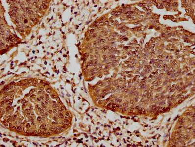 IHC image of RAC07424 diluted at 1:61.9 and staining in paraffin-embedded human cervical cancer performed on a Leica BondTM system. After dewaxing and hydration, antigen retrieval was mediated by high pressure in a citrate buffer (pH 6.0). Section was blocked with 10% normal goat serum 30min at RT. Then primary antibody (1% BSA) was incubated at 4? overnight. The primary is detected by a biotinylated secondary antibody and visualized using an HRP conjugated SP system.