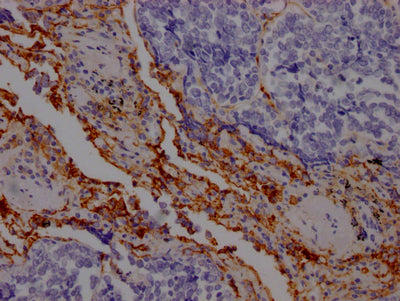 IHC image of RAC07426 diluted at 1:100 and staining in paraffin-embedded human lung cancer performed on a Leica BondTM system. After dewaxing and hydration, antigen retrieval was mediated by high pressure in a citrate buffer (pH 6.0). Section was blocked with 10% normal goat serum 30min at RT. Then primary antibody (1% BSA) was incubated at 4? overnight. The primary is detected by a Goat anti-rabbit IgG polymer labeled by HRP and visualized using 0.05% DAB.