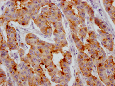 IHC image of RAC07429 diluted at 1:100 and staining in paraffin-embedded human breast cancer performed on a Leica BondTM system. After dewaxing and hydration, antigen retrieval was mediated by high pressure in a citrate buffer (pH 6.0). Section was blocked with 10% normal goat serum 30min at RT. Then primary antibody (1% BSA) was incubated at 4? overnight. The primary is detected by a Goat anti-rabbit IgG polymer labeled by HRP and visualized using 0.05% DAB.