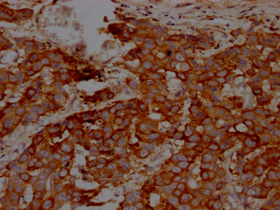IHC image of RAC07431 diluted at 1:100 and staining in paraffin-embedded human breast cancer performed on a Leica BondTM system. After dewaxing and hydration, antigen retrieval was mediated by high pressure in a citrate buffer (pH 6.0). Section was blocked with 10% normal goat serum 30min at RT. Then primary antibody (1% BSA) was incubated at 4? overnight. The primary is detected by a Goat anti-rabbit IgG polymer labeled by HRP and visualized using 0.05% DAB.