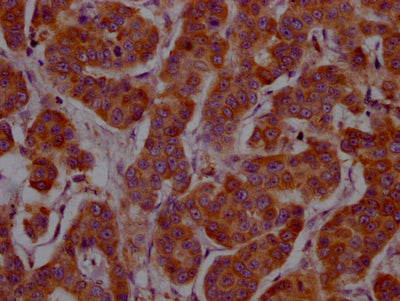 IHC image of RAC07436 diluted at 1:100 and staining in paraffin-embedded human breast cancer performed on a Leica BondTM system. After dewaxing and hydration, antigen retrieval was mediated by high pressure in a citrate buffer (pH 6.0). Section was blocked with 10% normal goat serum 30min at RT. Then primary antibody (1% BSA) was incubated at 4? overnight. The primary is detected by a Goat anti-rabbit IgG polymer labeled by HRP and visualized using 0.05% DAB.