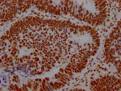 IHC image of RAC07438 diluted at 1:100 and staining in paraffin-embedded human ovarian cancer performed on a Leica BondTM system. After dewaxing and hydration, antigen retrieval was mediated by high pressure in a citrate buffer (pH 6.0). Section was blocked with 10% normal goat serum 30min at RT. Then primary antibody (1% BSA) was incubated at 4? overnight. The primary is detected by a Goat anti-rabbit IgG polymer labeled by HRP and visualized using 0.05% DAB.