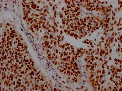 IHC image of RAC07438 diluted at 1:100 and staining in paraffin-embedded human cervical cancer performed on a Leica BondTM system. After dewaxing and hydration, antigen retrieval was mediated by high pressure in a citrate buffer (pH 6.0). Section was blocked with 10% normal goat serum 30min at RT. Then primary antibody (1% BSA) was incubated at 4? overnight. The primary is detected by a Goat anti-rabbit IgG polymer labeled by HRP and visualized using 0.05% DAB.
