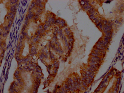 IHC image of RAC07440 diluted at 1:100 and staining in paraffin-embedded human endometrial cancer performed on a Leica BondTM system. After dewaxing and hydration, antigen retrieval was mediated by high pressure in a citrate buffer (pH 6.0). Section was blocked with 10% normal goat serum 30min at RT. Then primary antibody (1% BSA) was incubated at 4? overnight. The primary is detected by a Goat anti-rabbit IgG polymer labeled by HRP and visualized using 0.05% DAB.