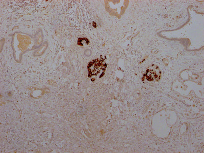 IHC image of RAC07443 diluted at 1:100 and staining in paraffin-embedded human pancreatic cancer performed on a Leica BondTM system. After dewaxing and hydration, antigen retrieval was mediated by high pressure in a citrate buffer (pH 6.0). Section was blocked with 10% normal goat serum 30min at RT. Then primary antibody (1% BSA) was incubated at 4? overnight. The primary is detected by a Goat anti-rabbit IgG polymer labeled by HRP and visualized using 0.05% DAB.