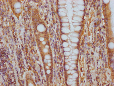 IHC image of RAC07446 diluted at 1:100 and staining in paraffin-embedded human colon cancer performed on a Leica BondTM system. After dewaxing and hydration, antigen retrieval was mediated by high pressure in a citrate buffer (pH 6.0). Section was blocked with 10% normal goat serum 30min at RT. Then primary antibody (1% BSA) was incubated at 4? overnight. The primary is detected by a Goat anti-rabbit IgG polymer labeled by HRP and visualized using 0.05% DAB.