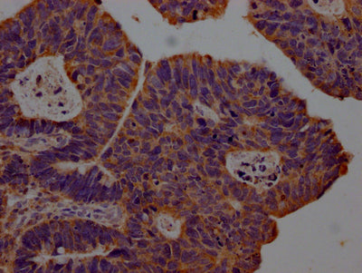 IHC image of RAC07448 diluted at 1:100 and staining in paraffin-embedded human ovarian cancer performed on a Leica BondTM system. After dewaxing and hydration, antigen retrieval was mediated by high pressure in a citrate buffer (pH 6.0). Section was blocked with 10% normal goat serum 30min at RT. Then primary antibody (1% BSA) was incubated at 4? overnight. The primary is detected by a Goat anti-rabbit IgG polymer labeled by HRP and visualized using 0.05% DAB.