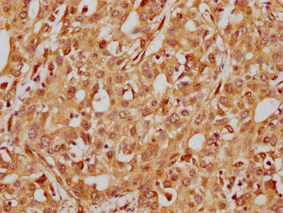 IHC image of RAC07456 diluted at 1:185 and staining in paraffin-embedded human liver cancer performed on a Leica BondTM system. After dewaxing and hydration, antigen retrieval was mediated by high pressure in a citrate buffer (pH 6.0). Section was blocked with 10% normal goat serum 30min at RT. Then primary antibody (1% BSA) was incubated at 4? overnight. The primary is detected by a biotinylated secondary antibody and visualized using an HRP conjugated SP system.