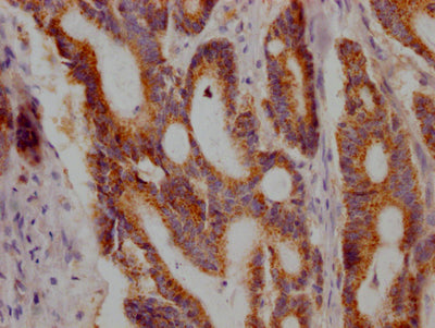 IHC image of RAC07458 diluted at 1:100 and staining in paraffin-embedded human colon cancer performed on a Leica BondTM system. After dewaxing and hydration, antigen retrieval was mediated by high pressure in a citrate buffer (pH 6.0). Section was blocked with 10% normal goat serum 30min at RT. Then primary antibody (1% BSA) was incubated at 4? overnight. The primary is detected by a Goat anti-rabbit IgG polymer labeled by HRP and visualized using 0.05% DAB.