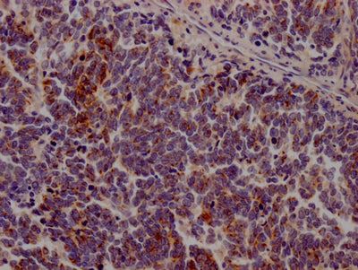 IHC image of RAC07460 diluted at 1:100 and staining in paraffin-embedded human lung cancer performed on a Leica BondTM system. After dewaxing and hydration, antigen retrieval was mediated by high pressure in a citrate buffer (pH 6.0). Section was blocked with 10% normal goat serum 30min at RT. Then primary antibody (1% BSA) was incubated at 4? overnight. The primary is detected by a Goat anti-rabbit IgG polymer labeled by HRP and visualized using 0.05% DAB.
