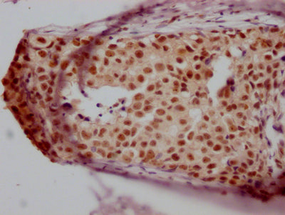 IHC image of RAC07461 diluted at 1:100 and staining in paraffin-embedded human breast cancer performed on a Leica BondTM system. After dewaxing and hydration, antigen retrieval was mediated by high pressure in a citrate buffer (pH 6.0). Section was blocked with 10% normal goat serum 30min at RT. Then primary antibody (1% BSA) was incubated at 4? overnight. The primary is detected by a Goat anti-rabbit IgG polymer labeled by HRP and visualized using 0.05% DAB.
