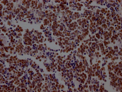 IHC image of RAC07463 diluted at 1:100 and staining in paraffin-embedded human lung cancer performed on a Leica BondTM system. After dewaxing and hydration, antigen retrieval was mediated by high pressure in a citrate buffer (pH 6.0). Section was blocked with 10% normal goat serum 30min at RT. Then primary antibody (1% BSA) was incubated at 4? overnight. The primary is detected by a Goat anti-rabbit IgG polymer labeled by HRP and visualized using 0.05% DAB.