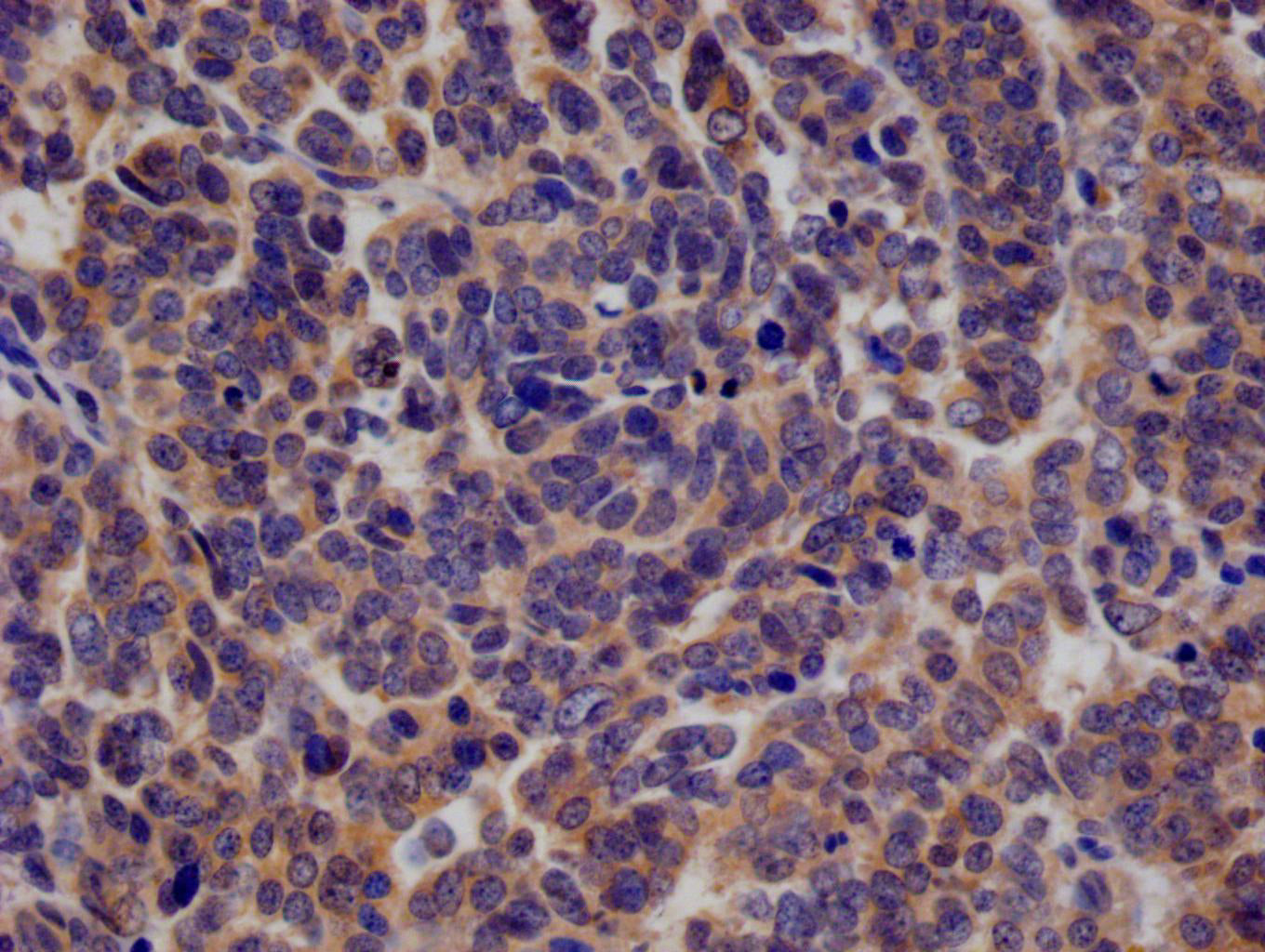 IHC image of RAC07465 diluted at 1:100 and staining in paraffin-embedded human ovarian cancer performed on a Leica BondTM system. After dewaxing and hydration, antigen retrieval was mediated by high pressure in a citrate buffer (pH 6.0). Section was blocked with 10% normal goat serum 30min at RT. Then primary antibody (1% BSA) was incubated at 4Â°C overnight. The primary is detected by a Goat anti-rabbit polymer IgG labeled by HRP and visualized using 0.05% DAB.