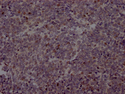 IHC image of RAC07470 diluted at 1:100 and staining in paraffin-embedded human lung cancer performed on a Leica BondTM system. After dewaxing and hydration, antigen retrieval was mediated by high pressure in a citrate buffer (pH 6.0). Section was blocked with 10% normal goat serum 30min at RT. Then primary antibody (1% BSA) was incubated at 4? overnight. The primary is detected by a Goat anti-rabbit IgG polymer labeled by HRP and visualized using 0.05% DAB.