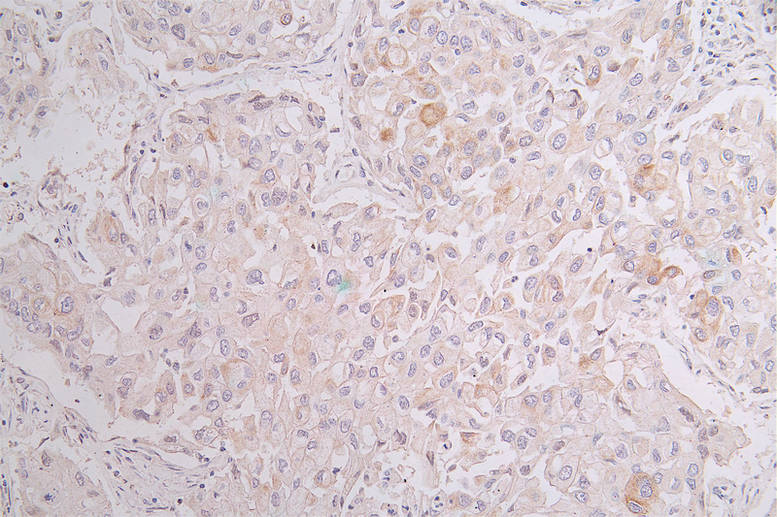 IHC image of RAC07471 diluted at 1:50 and staining in paraffin-embedded human lung cancer performed on a Leica BondTM system. After dewaxing and hydration, antigen retrieval was mediated by high pressure in a citrate buffer (pH 6.0). Section was blocked with 10% normal goat serum 30min at RT. Then primary antibody (1% BSA) was incubated at 4Â°C overnight. The primary is detected by a Goat anti-rabbit polymer IgG labeled by HRP and visualized using 0.34% DAB.
