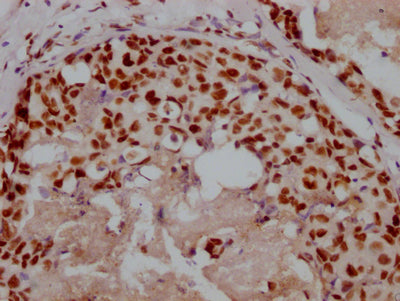 IHC image of RAC07474 diluted at 1:100 and staining in paraffin-embedded human breast cancer performed on a Leica BondTM system. After dewaxing and hydration, antigen retrieval was mediated by high pressure in a citrate buffer (pH 6.0). Section was blocked with 10% normal goat serum 30min at RT. Then primary antibody (1% BSA) was incubated at 4? overnight. The primary is detected by a Goat anti-rabbit IgG polymer labeled by HRP and visualized using 0.05% DAB.