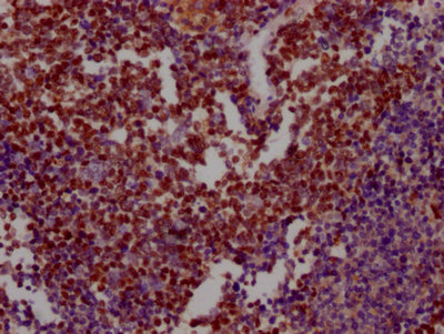 IHC image of RAC07474 diluted at 1:100 and staining in paraffin-embedded human lung cancer performed on a Leica BondTM system. After dewaxing and hydration, antigen retrieval was mediated by high pressure in a citrate buffer (pH 6.0). Section was blocked with 10% normal goat serum 30min at RT. Then primary antibody (1% BSA) was incubated at 4? overnight. The primary is detected by a Goat anti-rabbit IgG polymer labeled by HRP and visualized using 0.05% DAB.