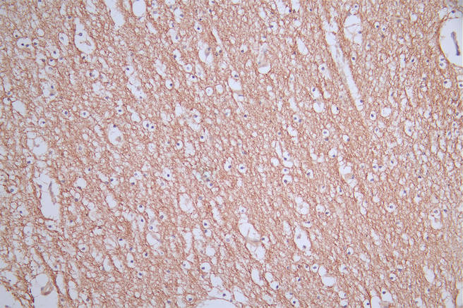 IHC image of RAC07475 diluted at 1:50 and staining in paraffin-embedded human brain tissue performed on a Leica BondTM system. After dewaxing and hydration, antigen retrieval was mediated by high pressure in a citrate buffer (pH 6.0). Section was blocked with 10% normal goat serum 30min at RT. Then primary antibody (1% BSA) was incubated at 4Â°C overnight. The primary is detected by a Goat anti-rabbit polymer IgG labeled by HRP and visualized using 0.76% DAB.