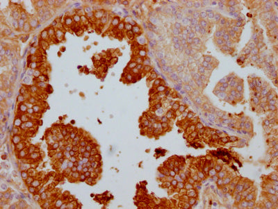 IHC image of RAC07477 diluted at 1:100 and staining in paraffin-embedded human prostate cancer performed on a Leica BondTM system. After dewaxing and hydration, antigen retrieval was mediated by high pressure in a citrate buffer (pH 6.0). Section was blocked with 10% normal goat serum 30min at RT. Then primary antibody (1% BSA) was incubated at 4? overnight. The primary is detected by a Goat anti-rabbit IgG polymer labeled by HRP and visualized using 0.05% DAB.