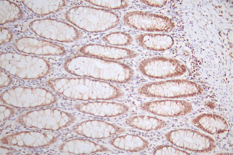 IHC image of RAC07482 diluted at 1:50 and staining in paraffin-embedded human rectal cancer performed on a Leica BondTM system. After dewaxing and hydration, antigen retrieval was mediated by high pressure in a citrate buffer (pH 6.0). Section was blocked with 10% normal goat serum 30min at RT. Then primary antibody (1% BSA) was incubated at 4Â°C overnight. The primary is detected by a Goat anti-rabbit polymer IgG labeled by HRP and visualized using 0.52% DAB.