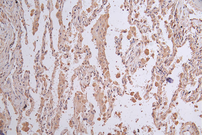 IHC image of RAC07485 diluted at 1:50 and staining in paraffin-embedded human lung cancer performed on a Leica BondTM system. After dewaxing and hydration, antigen retrieval was mediated by high pressure in a citrate buffer (pH 6.0). Section was blocked with 10% normal goat serum 30min at RT. Then primary antibody (1% BSA) was incubated at 4Â°C overnight. The primary is detected by a Goat anti-rabbit polymer IgG labeled by HRP and visualized using 0.26% DAB.