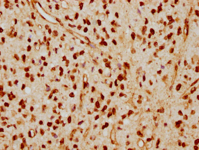 IHC image of RAC07486 diluted at 1:115 and staining in paraffin-embedded human glioma cancer performed on a Leica BondTM system. After dewaxing and hydration, antigen retrieval was mediated by high pressure in a citrate buffer (pH 6.0). Section was blocked with 10% normal goat serum 30min at RT. Then primary antibody (1% BSA) was incubated at 4? overnight. The primary is detected by a biotinylated secondary antibody and visualized using an HRP conjugated SP system.