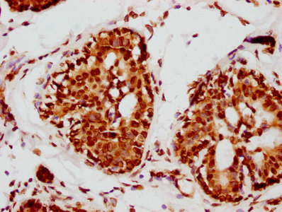 IHC image of RAC07486 diluted at 1:115 and staining in paraffin-embedded human breast cancer performed on a Leica BondTM system. After dewaxing and hydration, antigen retrieval was mediated by high pressure in a citrate buffer (pH 6.0). Section was blocked with 10% normal goat serum 30min at RT. Then primary antibody (1% BSA) was incubated at 4? overnight. The primary is detected by a biotinylated secondary antibody and visualized using an HRP conjugated SP system.