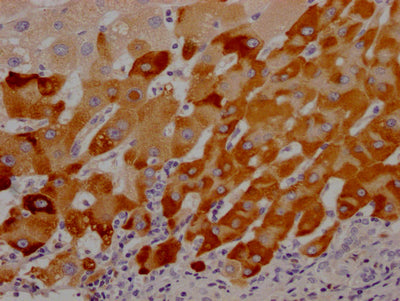 IHC image of RAC07489 diluted at 1:100 and staining in paraffin-embedded human liver cancer performed on a Leica BondTM system. After dewaxing and hydration, antigen retrieval was mediated by high pressure in a citrate buffer (pH 6.0). Section was blocked with 10% normal goat serum 30min at RT. Then primary antibody (1% BSA) was incubated at 4? overnight. The primary is detected by a Goat anti-rabbit IgG polymer labeled by HRP and visualized using 0.05% DAB.