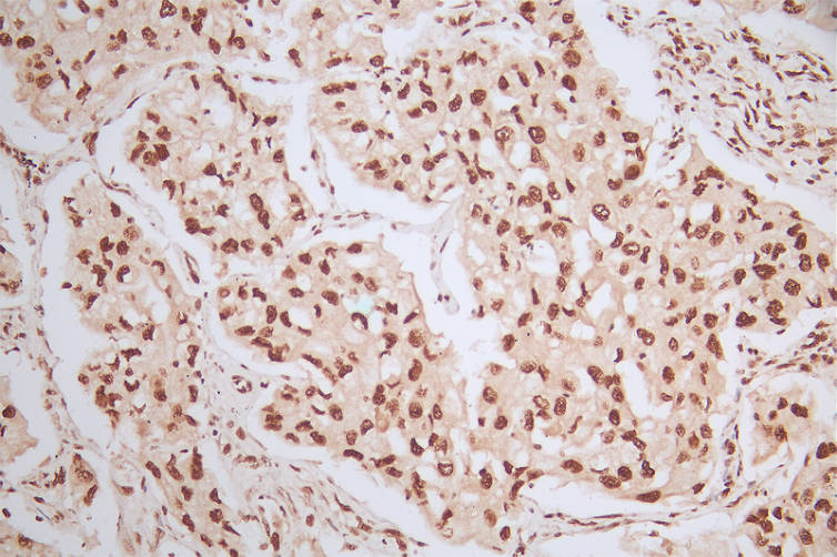 IHC image of RAC07509 diluted at 1:50 and staining in paraffin-embedded human lung cancer performed on a Leica BondTM system. After dewaxing and hydration, antigen retrieval was mediated by high pressure in a citrate buffer (pH 6.0). Section was blocked with 10% normal goat serum 30min at RT. Then primary antibody (1% BSA) was incubated at 4Â°C overnight. The primary is detected by a Goat anti-rabbit polymer IgG labeled by HRP and visualized using 0.57% DAB.