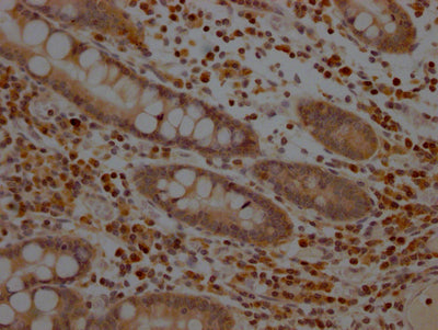 IHC image of RAC07510 diluted at 1:100 and staining in paraffin-embedded human colon cancer performed on a Leica BondTM system. After dewaxing and hydration, antigen retrieval was mediated by high pressure in a citrate buffer (pH 6.0). Section was blocked with 10% normal goat serum 30min at RT. Then primary antibody (1% BSA) was incubated at 4? overnight. The primary is detected by a Goat anti-rabbit IgG polymer labeled by HRP and visualized using 0.05% DAB.
