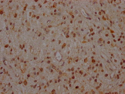 IHC image of RAC07511 diluted at 1:100 and staining in paraffin-embedded human glioma cancer performed on a Leica BondTM system. After dewaxing and hydration, antigen retrieval was mediated by high pressure in a citrate buffer (pH 6.0). Section was blocked with 10% normal goat serum 30min at RT. Then primary antibody (1% BSA) was incubated at 4? overnight. The primary is detected by a Goat anti-rabbit IgG polymer labeled by HRP and visualized using 0.05% DAB.