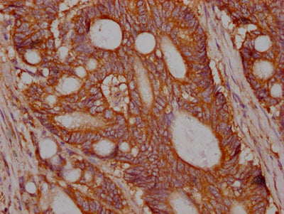 IHC image of RAC07513 diluted at 1:100 and staining in paraffin-embedded human colon cancer performed on a Leica BondTM system. After dewaxing and hydration, antigen retrieval was mediated by high pressure in a citrate buffer (pH 6.0). Section was blocked with 10% normal goat serum 30min at RT. Then primary antibody (1% BSA) was incubated at 4? overnight. The primary is detected by a Goat anti-rabbit IgG polymer labeled by HRP and visualized using 0.05% DAB.
