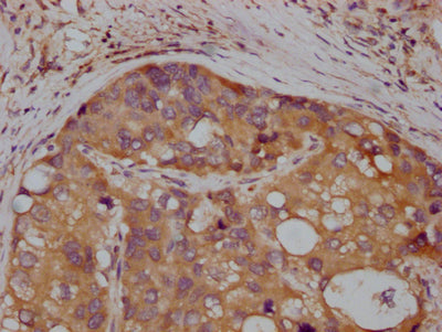 IHC image of RAC07513 diluted at 1:100 and staining in paraffin-embedded human liver cancer performed on a Leica BondTM system. After dewaxing and hydration, antigen retrieval was mediated by high pressure in a citrate buffer (pH 6.0). Section was blocked with 10% normal goat serum 30min at RT. Then primary antibody (1% BSA) was incubated at 4? overnight. The primary is detected by a Goat anti-rabbit IgG polymer labeled by HRP and visualized using 0.05% DAB.